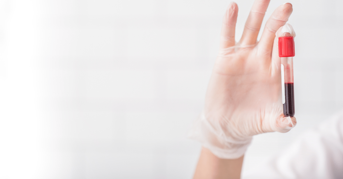 What Is A Tempus Blood Test How PAXgene® and Tempus™ blood tubes influence RNA expression signatures